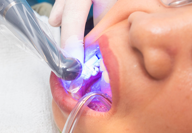 Dental patient receiving cosmetic bonding treatment
