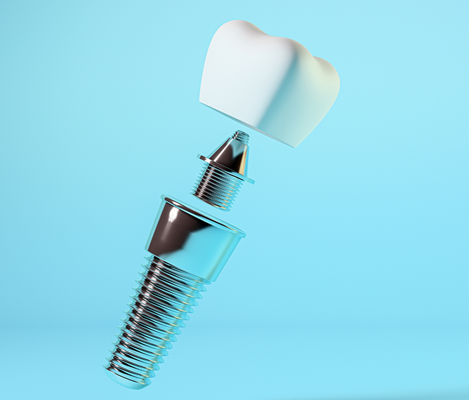 Illustration of a dental implant in West Bridgewater