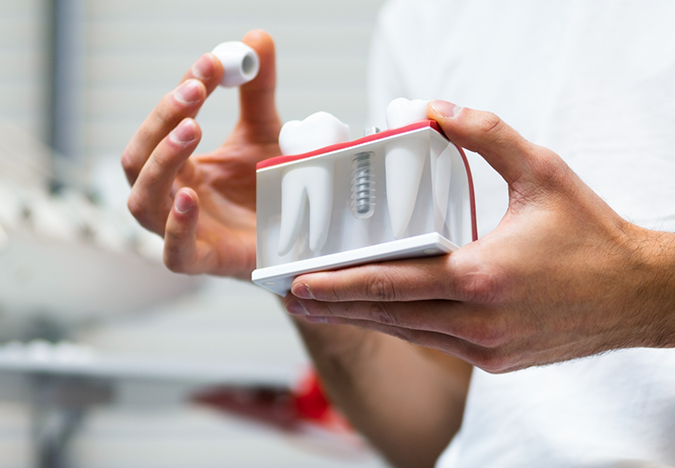 Dentist holding a model of a dental implant between two natural teeth