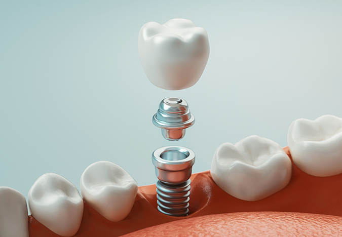 Illustration of a dental implant replacing a missing tooth