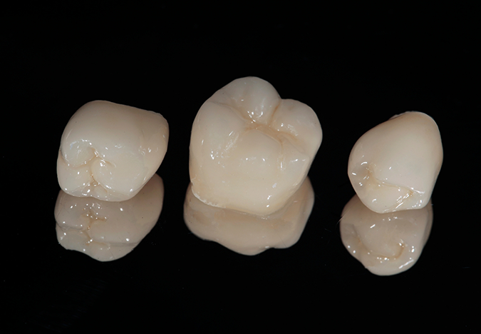 Three tooth-colored dental crowns