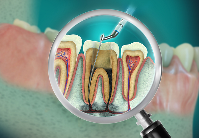 Illustration of a thin dental instrument performing root canal treatment on a tooth