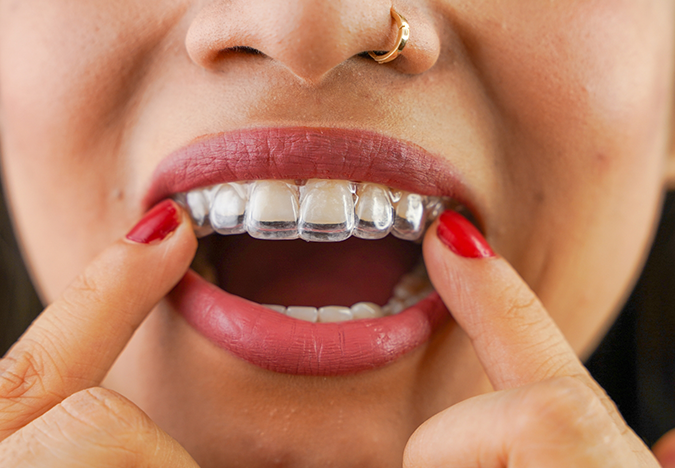 Close up of a woman pointing to the clear aligner over her teeth