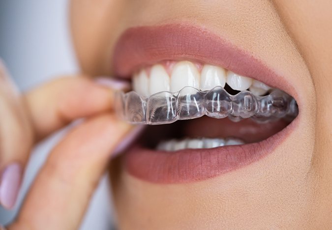 Close up of a person placing a clear aligner over their teeth