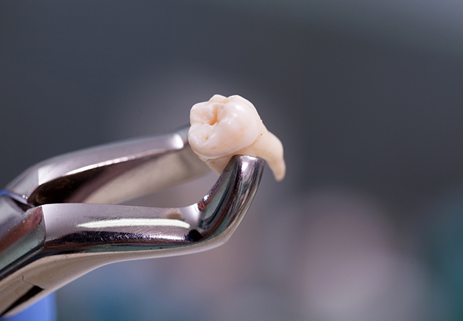 Dental forceps holding an extracted tooth